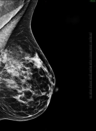 Y las mujeres hispanas tienen menos probabilidad de desarrollar cáncer de mama que las mujeres blancas no hispanas…