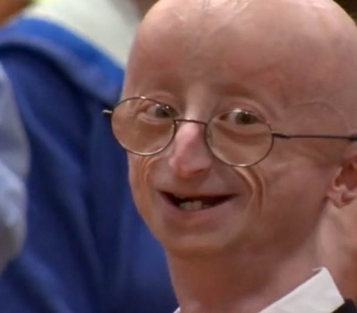 A tan sólo 17 años de edad, Sam tenía el aspecto de un anciano de unos 70 años.