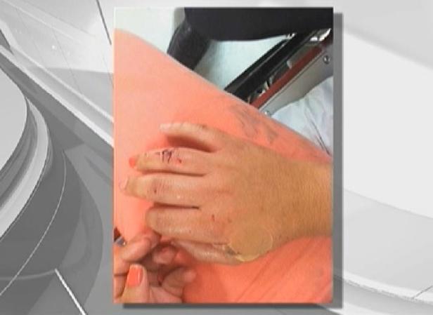 La joven de 19 años de edad, fue víctima de mordiscos en la cara, la mano y un muslo.