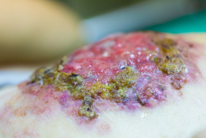 En casos extremos, el riesgo de infección puede derivar en la necrosis de la areola y el pezón.