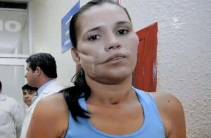 Karla Flores, sobrevivió milagrosamente tras sufrir el impacto de una granada de fusil que se le incrustó en la cara y que los médicos en una osada intervención quirúrgica lo extrajeron sin que estallara.
