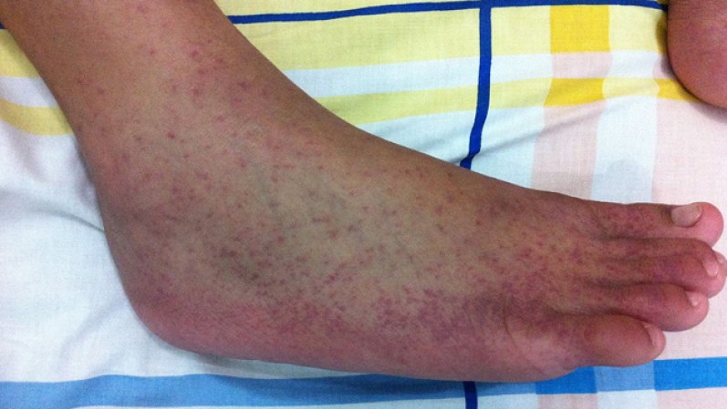 Los síntomas del virus chikungunya son parecidos a la artritis. Dolor e inflamación en la articulaciones, que pueden durar de por vida. Hasta el momento no hay cura. En América se han registrado casos en países del Caribe, México y El Salvador.