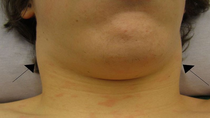 Virus del Beso. Se transmite a través de la saliva. Los síntomas del virus pueden aparecer entre la cuarta y la sexta semana, luego de contraerse.