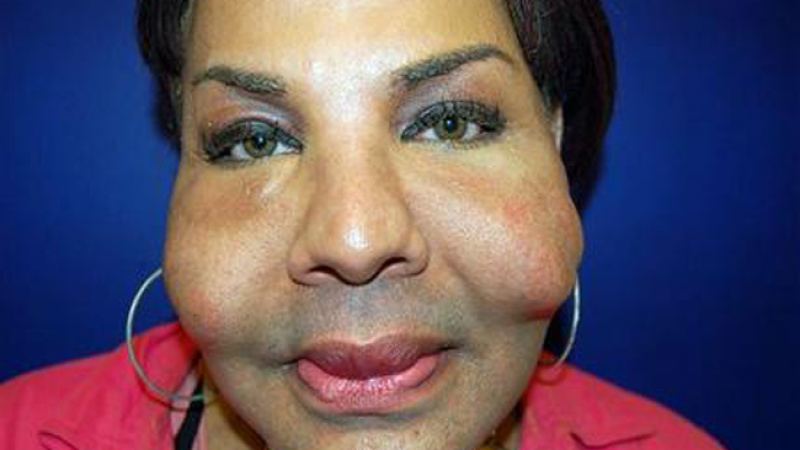 Rajinda Narinseich, víctima de la silicona.