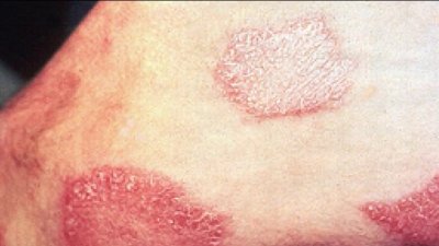 Alertan sobre aumento de casos de lepra en Florida