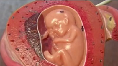 Normas de salud tras la prohibición del aborto en Florida