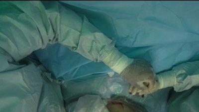 Cirugía intrauterina en hospital Jackson salva la vida del bebé de una madre cubana