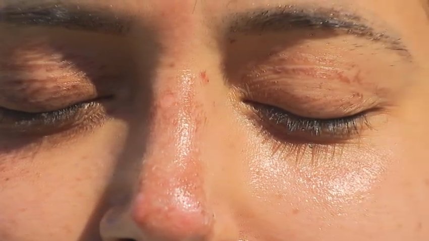 Abigail Rivera, a food truck owner in Long Beach, shows the second-degree burns she has on her eyes and nose following an incident at work.