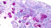 ¿Qué es la ciclosporiasis? Florida reporta decenas de casos, se incluyen Miami-Dade y Broward
