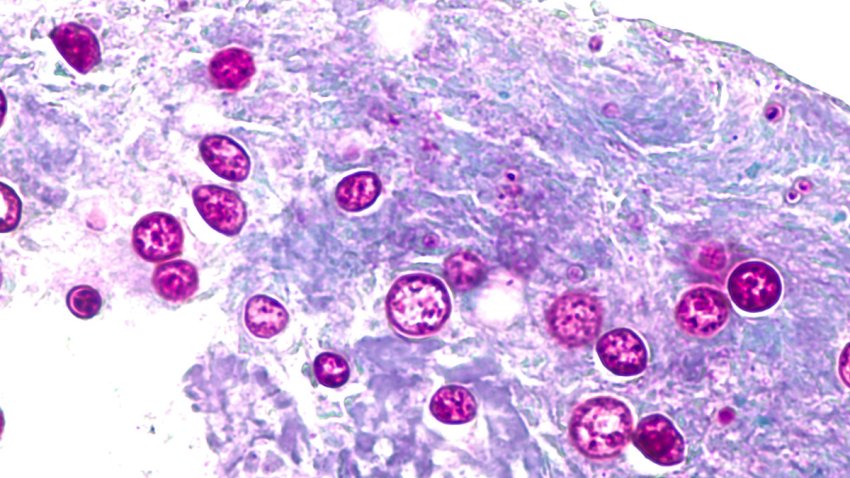 Micrograph of a granuloma containing spherules of Coccidiosis immitis in a patient with  coccidiomycosis, stained with PAS.  This fungus is common in the southwest United States.