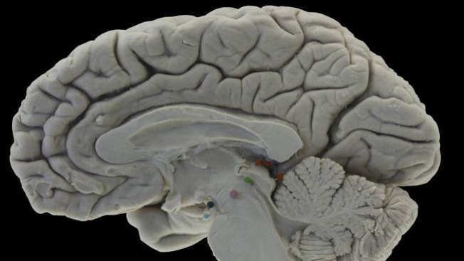 Avance médico en lucha contra Alzheimer