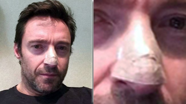 Jackman tratado de cáncer otra vez